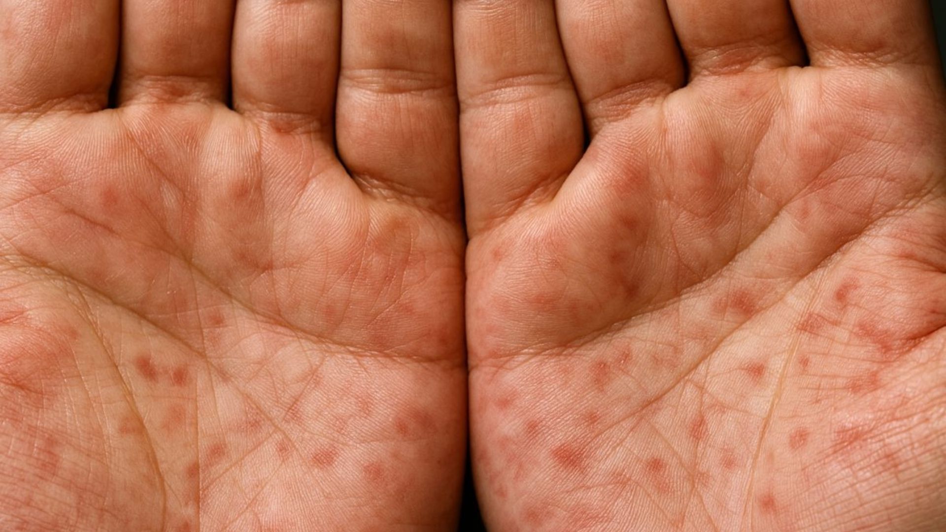 Close-up of a skin rash on the palms of the hands, an example of the body rash that can occur during acute HIV infection